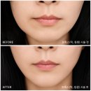 강남피부과, 강남역 턱보톡스 + 침샘보톡스 내돈내산 후기