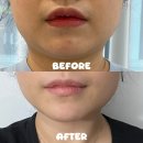 기도원 맞은 편 화장실 | 강남 온다리프팅 루팡주사 솔직후기 한달 변화 사진(가격, 효과, 통증)