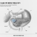 "당뇨병 없어도 공복 혈당 높으면 췌장암 위험 증가" 이미지