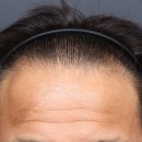 정목초교 | 신정동탈모병원 남성형 탈모 3단계 비수술 치료 리제네라 액티바 후기