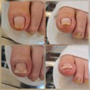 뷰티 라이프 샵 | 광주 농성동 내성발톱 노랗고 아픈 발톱 이렇게 달라졌어요! 뷰티업라이프 페디네일