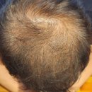 혁신뷰티의원 | 남성 정수리두피문신, 실패 없이 자연스럽게 채우는 업체 선택 기준 5가지 (후회 없는 선택법)