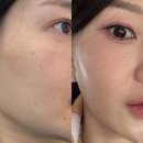 샤인 | 홍대피부과 리쥬란힐러 쥬베룩(리쥬베룩) 더마샤인 스킨부스터 후기