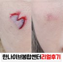 안양봉합진료 얼굴상처 치료 받고 왔어요 [사진주의]