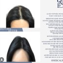 원스칼프 이미지