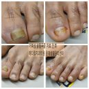 점핑클럽 시화MTV | 🦶[시흥 거북섬 · 오이도 인근] 사우나, 골프 후 발이 가렵다면?가족까지 전염되는 무좀, 발톱무좀 지금...