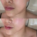 노진희피부연구소 | 울산 리프팅 노진희피부연구소 써마튠 후기