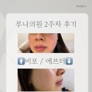 압구정 루비레이저 전문 | 루나 의원 기다리고 기다렸던.. 2주 차 후기