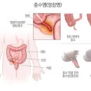 남자 여자 오른쪽 아랫배 통증 찌릿 원인 오른쪽 아랫배 통증 콕콕 이미지