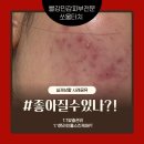 신통한피부관리 | 반복되는 여드름, 압출만으로 좋아질까요? 부천 신중동 여드름관리 후기