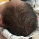 아이엠피부과 | 대전 아이엠피부과 ) 아기 혈관종치료후기