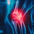 예산정형외과 네이버블로그