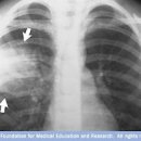 급성 폐렴 초기 원인 전염 (기침가래 노란가래) 이미지