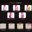 대구지방흡입-PPC주사 지방파괴주사 지방분해과정[대구성형외과] 이미지