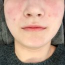 스마트메디 | [후기] 수완지구 에스테틱 여드름 관리 전문 "365메디스킨" 피부 관리 후기