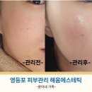 해움에스테틱 | 영등포피부관리 해움에스테틱 세멘시트 물방울리프팅 후기