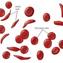 빈혈 악성 만성 각각에 대한 원인 및 증상, 치료 및 예방 까지 이미지