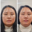 수평한의원 | 안면비대칭교정 논현역한의원 턱관절장애 직접 받아본 후기