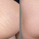 스칼프디자인센터 네이버블로그