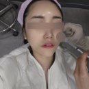 멍, 타임 | 압구정로데오역피부과 강남 쥬베룩 스킨부스터 4cc 멍 엠보 다운타임 솔직후기