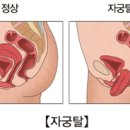 자궁탈출증 (Uterine Prolapse) 이미지