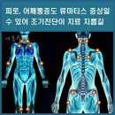 ◑ 피로, 어깨통증도 류마티스 증상일 수 있어… 이미지