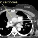 면역기관에 생기는 흉선종과 흉선암에 대하여 이미지