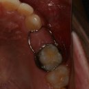 광양서울앤치과의원 | 일찍 빠졌을 때 공간유지장치, 빈자리 유지를 넘어선 역할과 숨은 공간 Leeway space의 비밀. 잠실교정치과