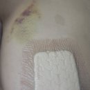 이진약국 | [후기] 아산 미유외과 맘모톰수술 리얼리뷰! 치밀유방+조직검사부터 수술, 보험까지 한방정리