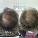 은평구 두피문신 연신내탈모 메이두 엄마 탈모고민 해결한 후기