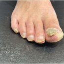 목포발톱무좀 두꺼운발톱 뷰티업라이프 가온네일&amp;페디에서 해결했어요!
