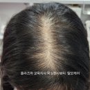시엔헤어지사점 | 수원콜드플라즈마 후 30대 여성 정수리탈모 12회만의 변화