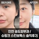 뷰티by연 | 인천 송도피부과 '슈링크 스킨보톡스' 2주 솔직후기 (통증,붓기,멍,가격)