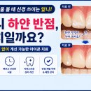 뉴욕바른라인치과의원 | 신당동치과 앞니 하얀 반점 미백과 아이콘레진으로 지우기