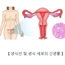 생식선 및 생식 세포의 신생물[Gonadal and germ cell neoplasma]소아청소년질환, 여성질환, 종양혈액질환 이미지