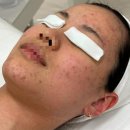 남문화장품 | 안양 여드름 압출 에스테틱 잘하는 곳 가격과 변화후기