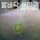 노들담한의원 | 발바닥 사마귀 치료, 자가 치료로 없앨 수 있을까?