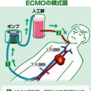 인공폐(人工肺) 「에크모(ECMO)」는 무엇? 이미지