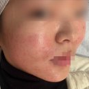 강남역 피부관리 한의원 비용 스킨부스터 mts 염증관리 트러블 컨택터 리쥬런 엑소즘 차이