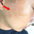 트러블 개선 잠실피부관리 안나뷰띠끄 스킨스켈링과 화이트멜라소닉 플라즈마 관리후기