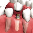 임플란트 종류와 임플란트 진행은? 이미지