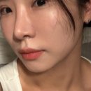 케이트의원 | 케이트의원 홍대 울트라콜 솔직 후기 :: 다크서클·눈밑꺼짐 고민으로 선택한 이유(부작용,붓기,전후)