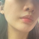 청담도트의원 | [청다 피부과] 청담 슈링크유니버스 얼굴 라인 정리하기 ! 만족 후기 :)