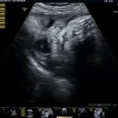 분당-40 | 40주 진료 후기 | 진통은 없고… 분당제일여성병원에서 유도분만 예약했어요!