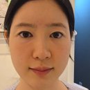 줄기세포 피부주사 한달 후기 | 조아성형외과 피부재생 시술