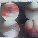 십자인대 재건술 병역문제 도움 청합니다. 이미지