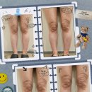 윤희뷰티 | [다리다이어트/이오팻주사] 무릎살 집중 관리 후기 💉✨ 자연스럽게 하체라인 정리한 리얼 경험담