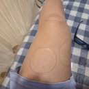 논현정형외과의원 | 무릎 슬개골염? 운동 후 무릎 통증, ESWT 체외충격파 치료 효과는?