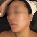서해상동주유소 | 부천 압출 잘하는 곳 상동 여드름 관리 브이메디스파 부천점 솔직후기
