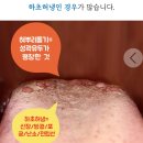 야 얘들아 니네도 혀 존나 안쪽 뿌리부분에 돌기 우두두 나있음?? (혐주의 내사진 아님) 이미지